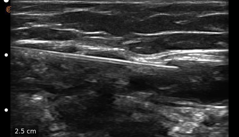 https://aexelbiomed.com.vn/wp-content/uploads/2026/06/Axillary_Nerve_injection_needle-1.jpg