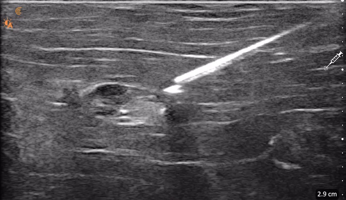 https://aexelbiomed.com.vn/wp-content/uploads/2026/06/Clarius-Needle-Enhance.jpg