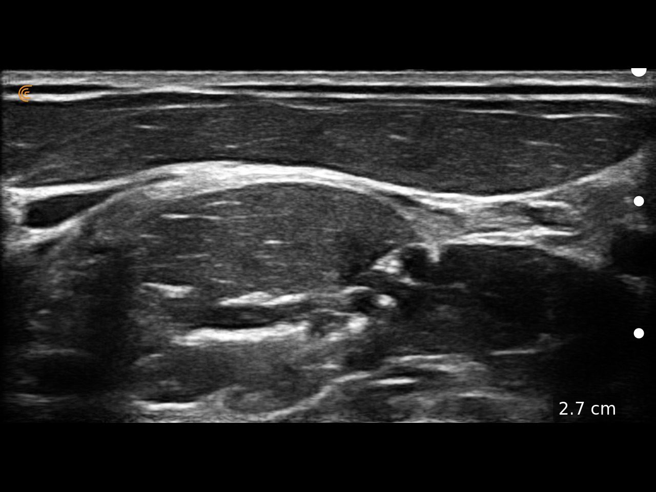 https://aexelbiomed.com.vn/wp-content/uploads/2026/06/Interscalene-Brachial-Plexus.jpeg