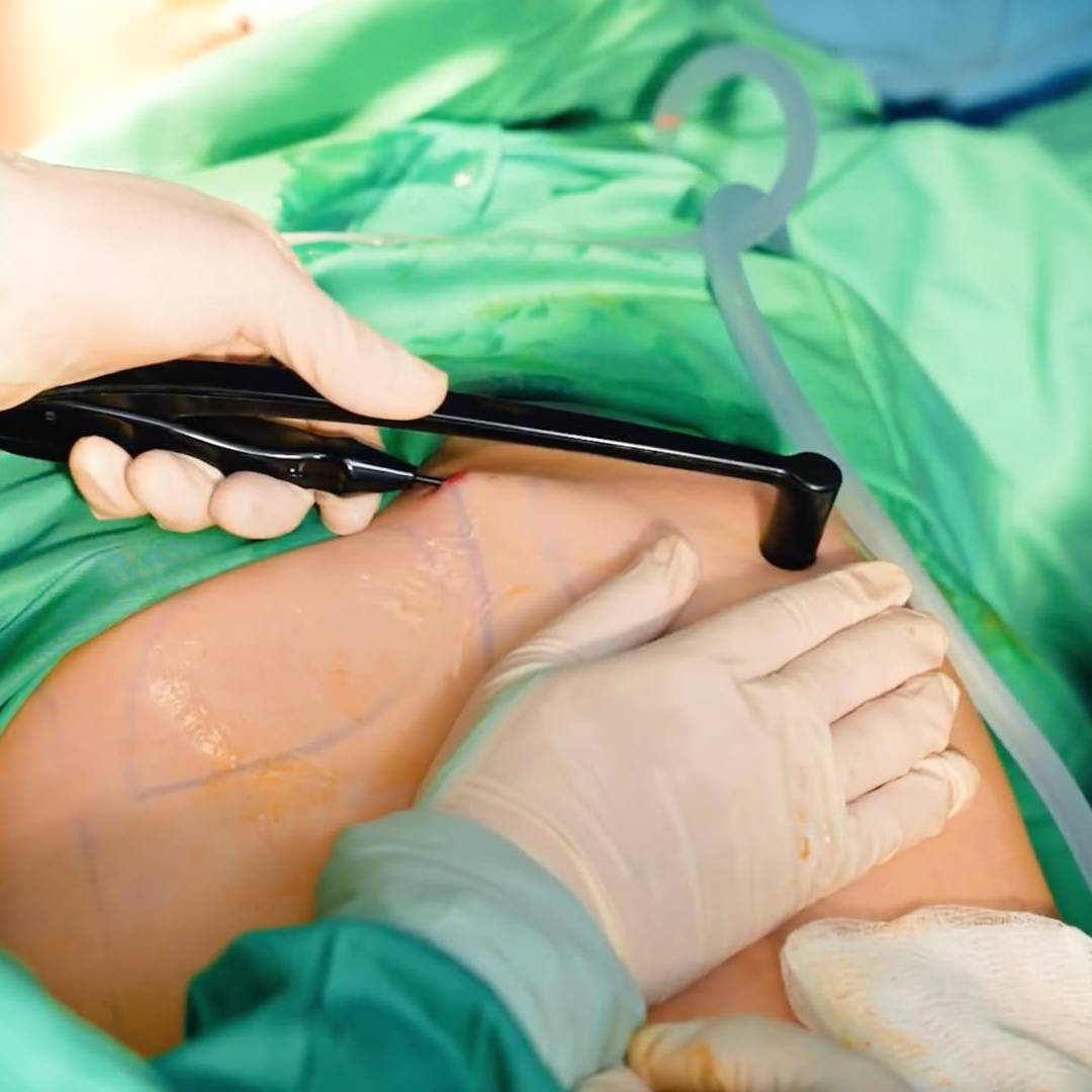 https://aexelbiomed.com.vn/wp-content/uploads/2026/09/IGNITERF-01.jpg